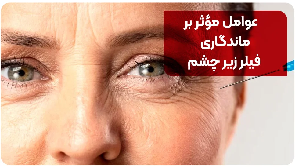 عوامل مؤثر بر ماندگاری فیلر زیر چشم